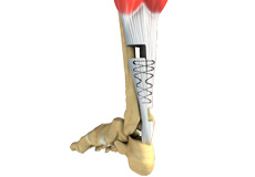 Tendon Repair Surgery