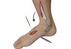 Tendon Transfer