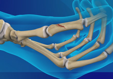 Thumb Fracture