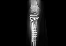 Traumatic Limb Salvage Surgery