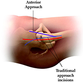 ANTERIOR ADVANTAGE&trade; Hip Replacement