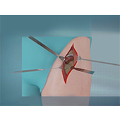 Anterior Hip Replacement