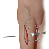 Complex Hip Reconstruction Surgery