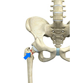Femoral Neck Fracture