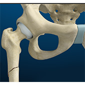 Femoral Shaft Fracture