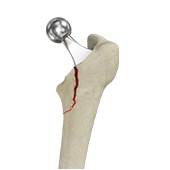 Femur Fracture