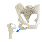Hip Dislocation