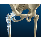 Hip Fracture Surgery