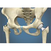 Hip Hemiarthroplasty