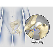 Hip Instability