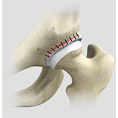 Hip Reconstruction