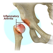 Inflammatory Arthritis of the Hip