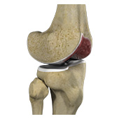 Knee Arthritis