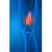 Knee Fracture