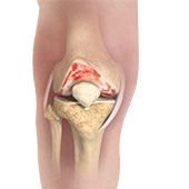 Knee Osteoarthritis
