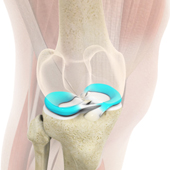 Knee Strengthening Exercises for Meniscal Tears