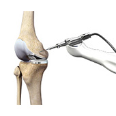 MAKO Robotic-Arm Assisted Technology for Partial Knee Replacement