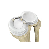 Meniscal Injuries