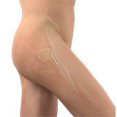Minimally Invasive Hip Replacement - Direct Anterior Approach