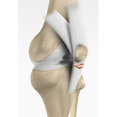 Patellar Tendon Rupture