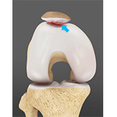 Patellofemoral Arthritis