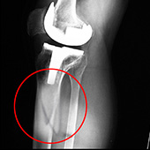 Periprosthetic Knee Fractures