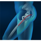 Posterior Hip Replacement