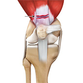 Quadriceps Tendon Rupture