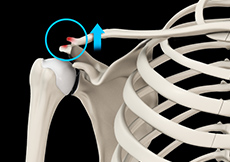 AC Joint Dislocation/Acromioclavicular Joint Dislocation