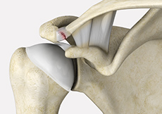AC Joint Separation