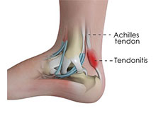 Achilles Tendinitis