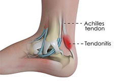 Achilles Tendinitis Treatment
