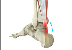 Achilles Tendon Repair