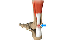 Achilles Tendon Rupture