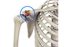 Acromioclavicular (AC) Joint Osteoarthritis