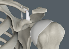 Acromioclavicular (AC) Joint Reconstruction