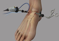 Ankle Arthroscopy