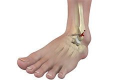 Ankle Fractures