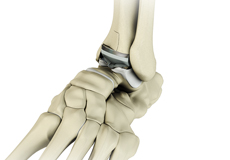 Ankle Joint Replacement