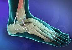 Ankle Ligament Reconstruction