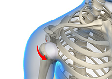 Anterior Shoulder Instability