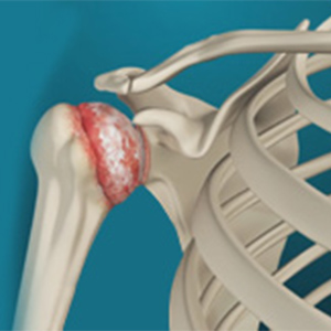 Arthritis of the Shoulder