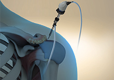 Arthroscopic Acromioplasty