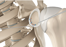 Arthroscopic Bankart Repair