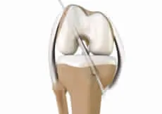 Arthroscopic Debridement