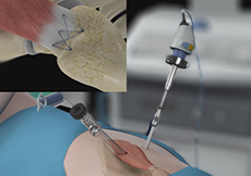 Arthroscopic Gluteus Medius Tendon Repair