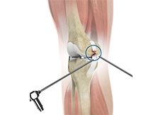 Arthroscopic Reconstruction of the Knee for Ligament Injuries