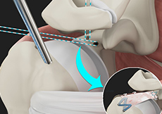 Arthroscopic Superior Capsular Reconstruction