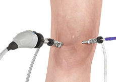 Arthroscopic Surgery