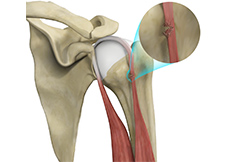 Bicep Tendon Rupture